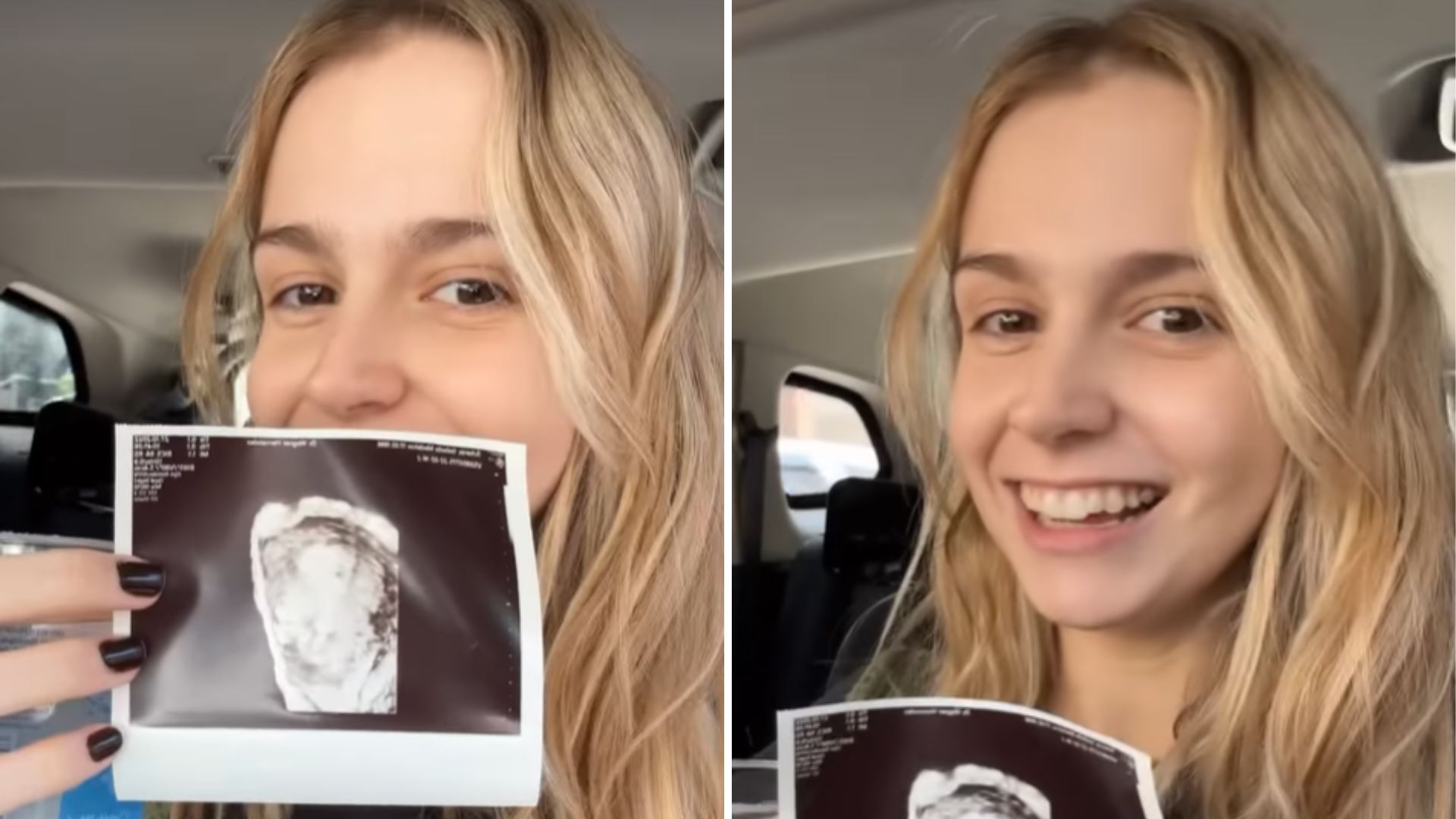Isa Scherer investe em método contraceptivo após parto dos gêmeos: “Melhor decisão”