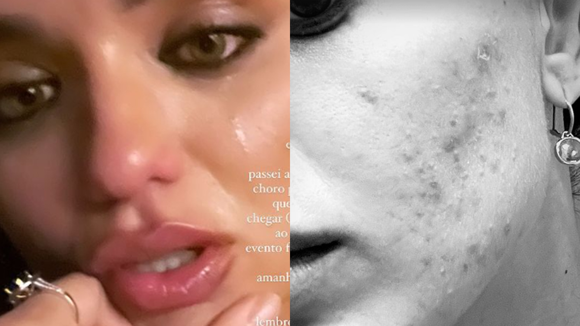 Ex-BBB Rafa Kalimann mostra acne severa e desabafa: “Rosto quente”