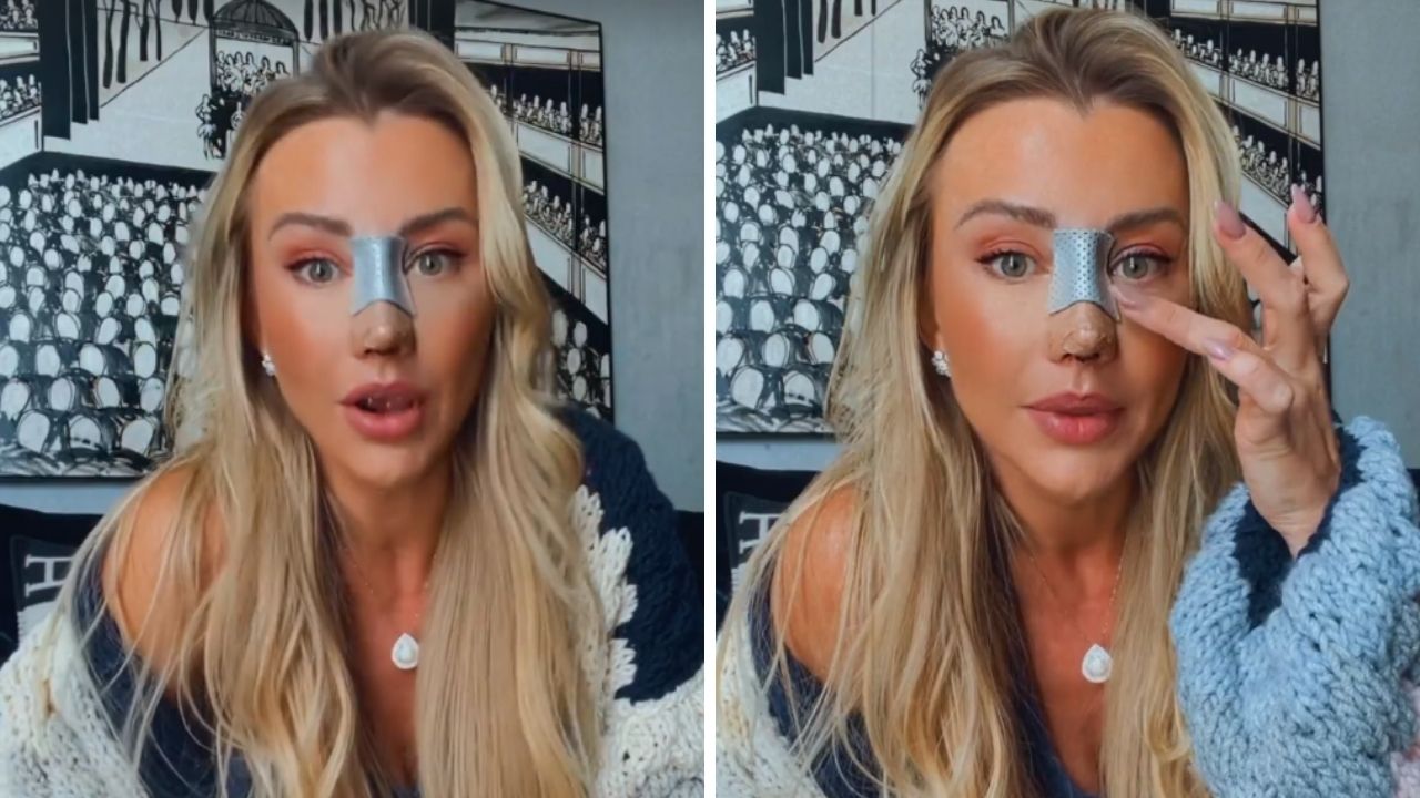Empinadinho! Ana Paula Siebert retira curativos e mostra resultado de cirurgia no nariz: “Muito feliz”