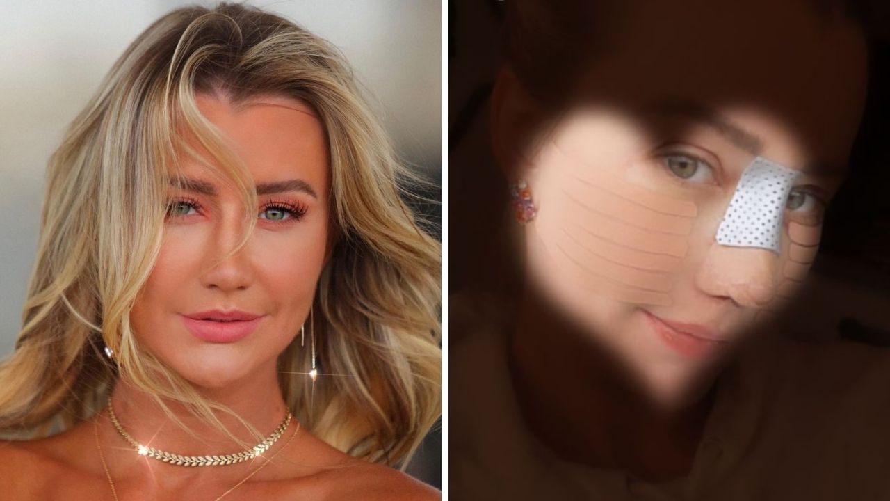 Ana Paula Siebert se submete a segunda rinoplastia e diz estar se recuperando bem: “Narizinho novo”