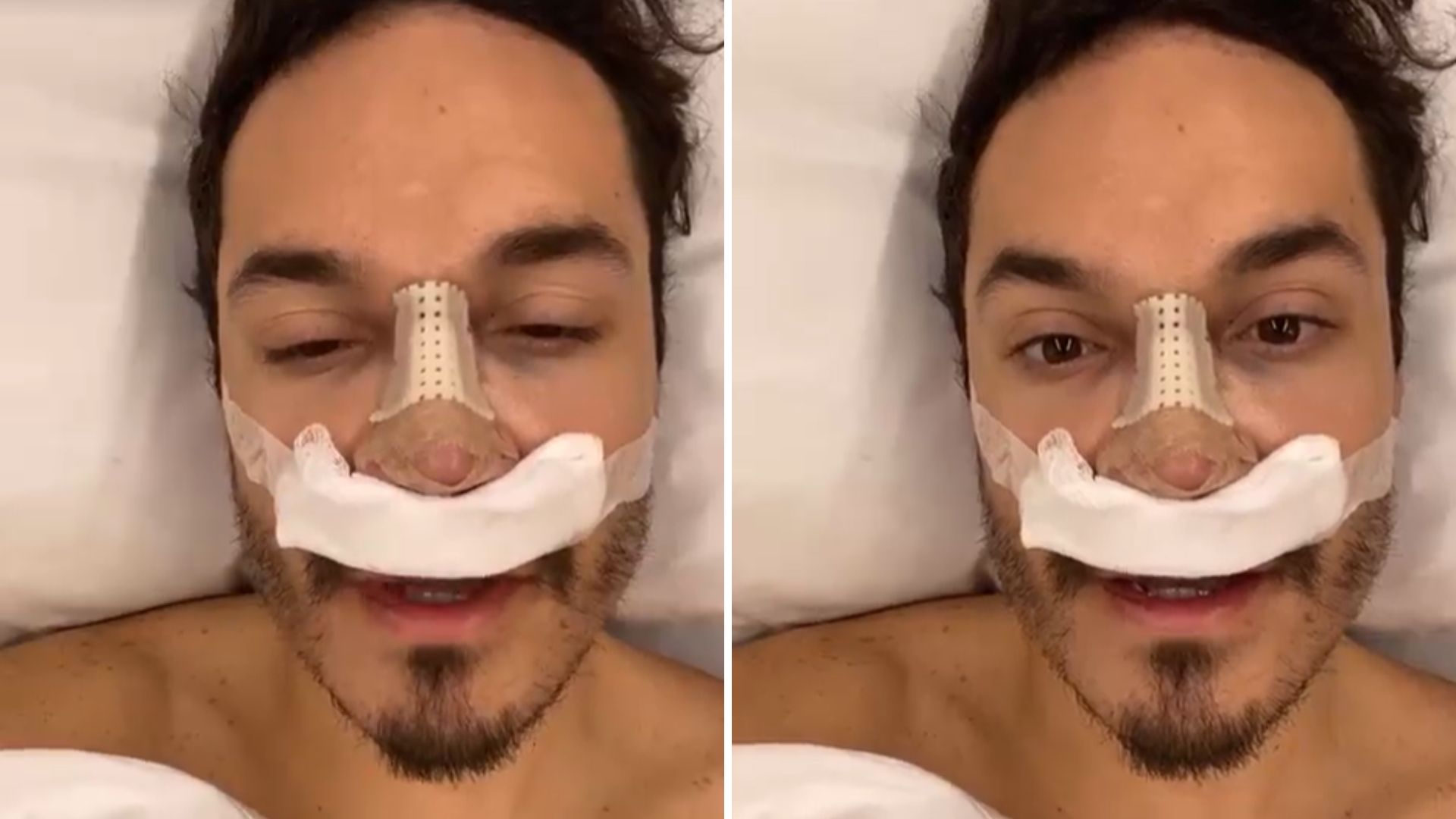 Ex-BBB Eliezer surge irreconhecível após procedimento no nariz: “Feliz demais”