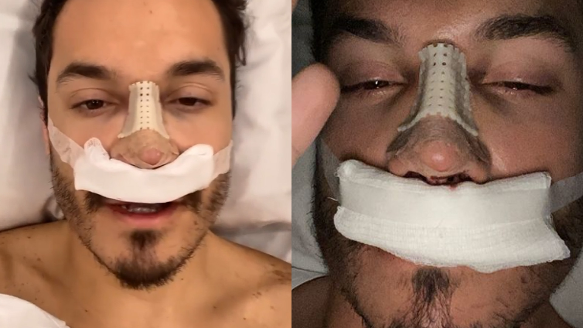 Ex-BBB Eliezer aparece após rinoplastia e revela que tirou pedaço da costela: “Quero ver”