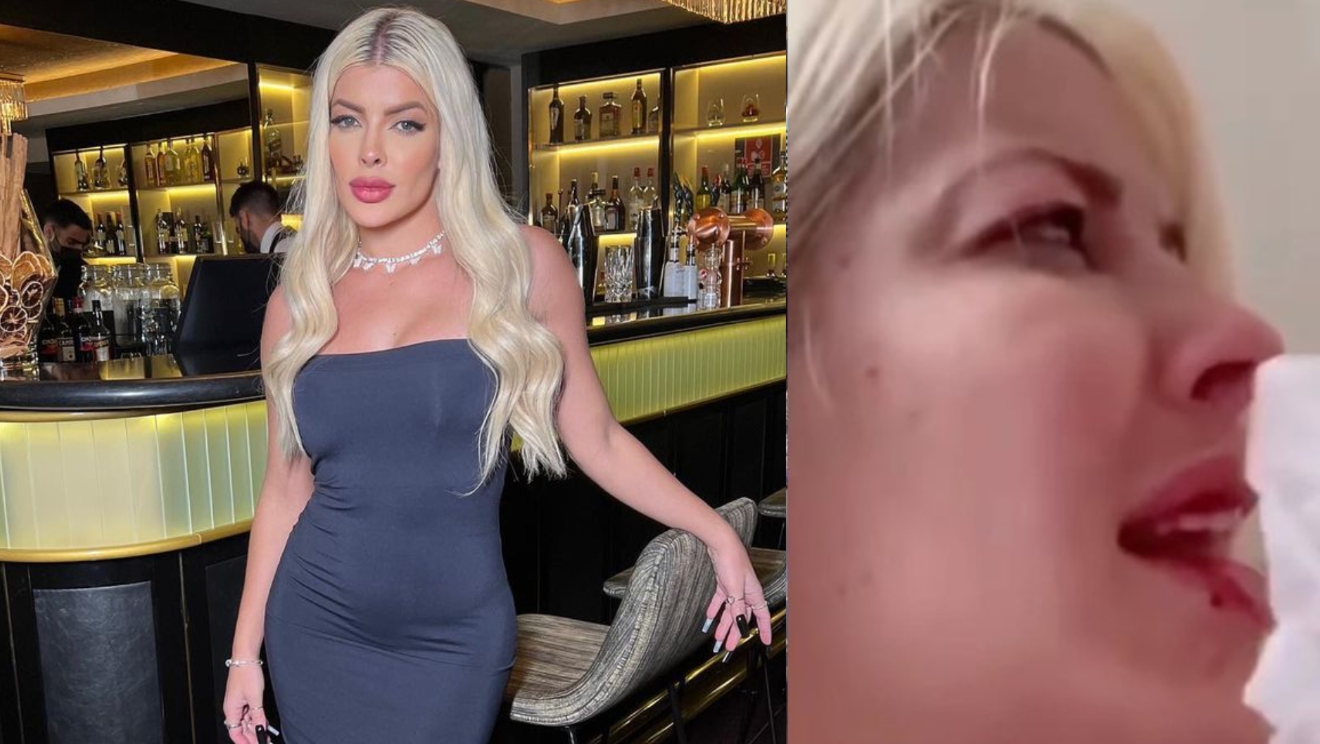 Ex-BBB Jaquelline Grohalski foi agredida pelo namorado e tem estado de saúde atualizado: “Abalada”