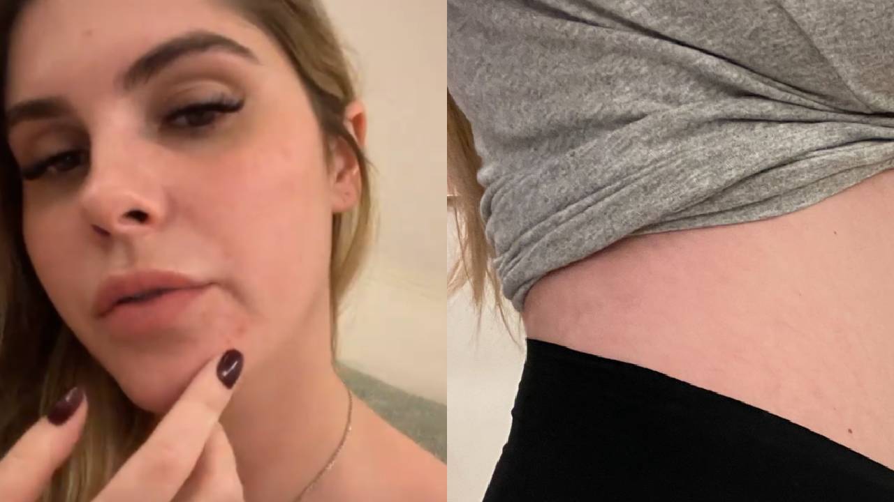 Aos dois meses, Bárbara Evans mostra barriguinha de grávida e relata surto de espinhas no rosto: “Sem filtro”