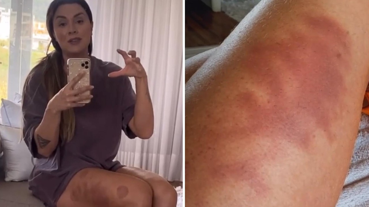 Juju Salimeni assusta ao mostrar perna tomada por hematomas: “Dói na alma, fica marcado”