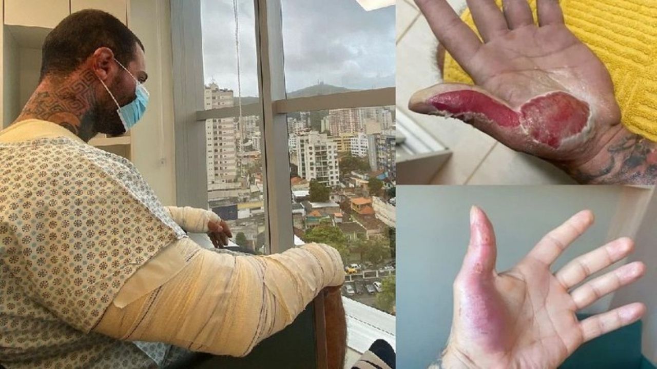 Leo Stronda mostra antes e depois de acidente grave em casa: “Eu tive 30% do corpo queimado”